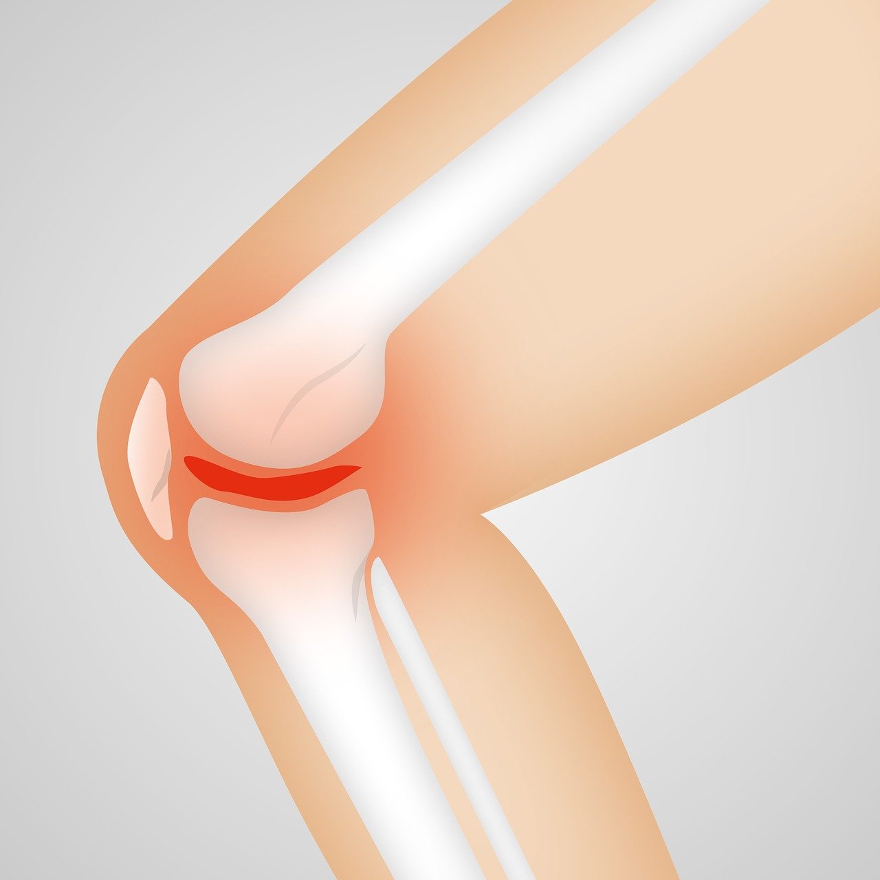 Arthrose vorbeugen und behandeln