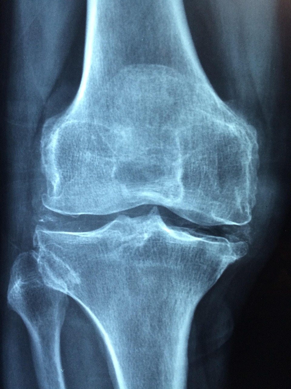 osteoarthritis ist eine häufige gelenkerkrankung, die schmerzen, steifheit und eingeschränkte beweglichkeit verursacht. erfahren sie mehr über ursachen, symptome und behandlungsmöglichkeiten.
